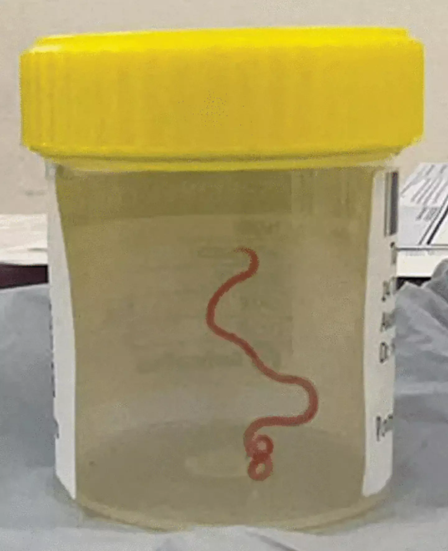 The parasite was successfully removed last year.