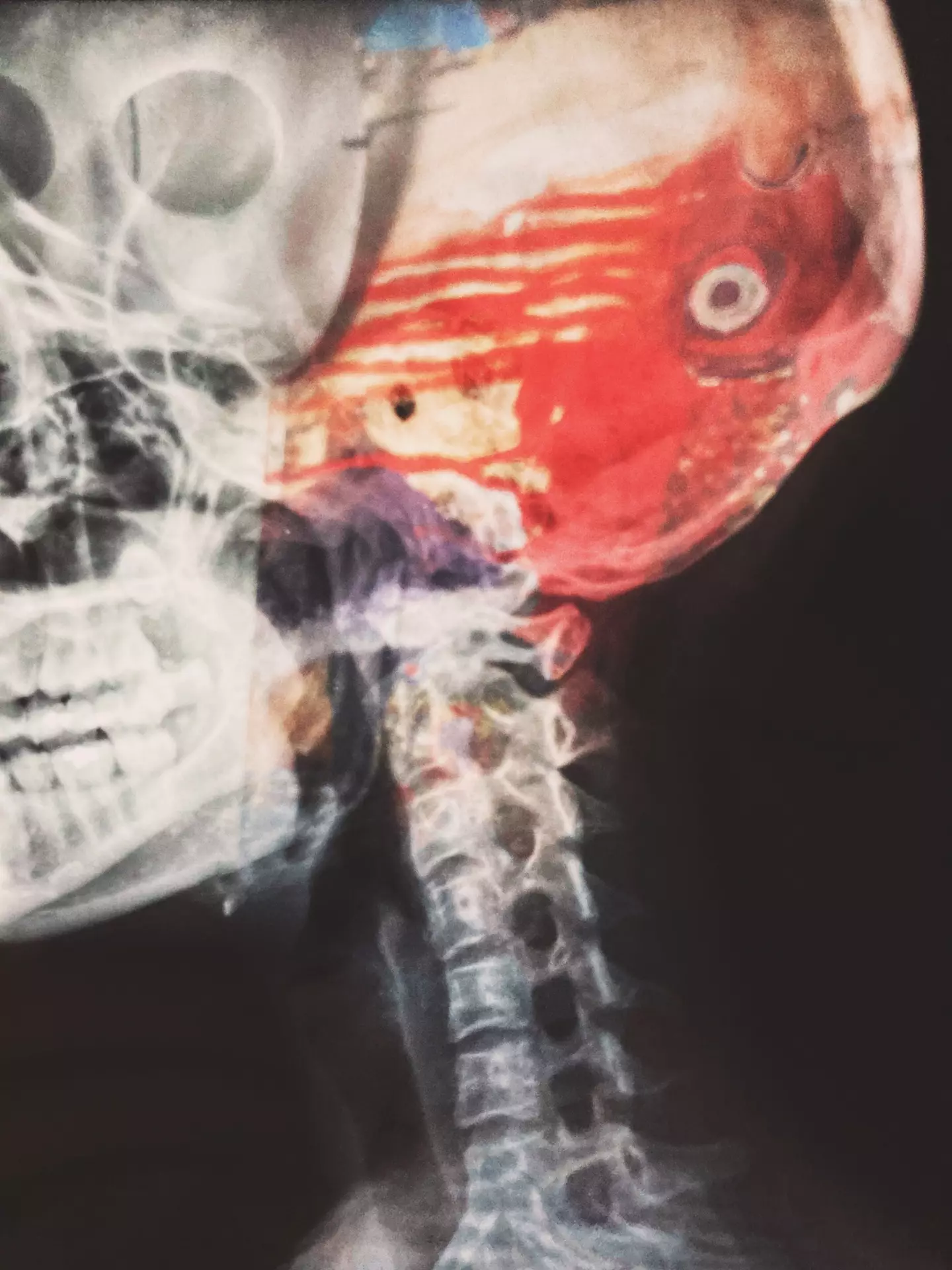 The injury is fatal 70 percent of the time.