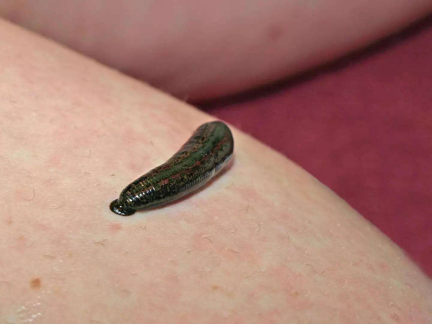Leeches have been used to help with 'hypertension, varicose veins, hemorrhoids, skin problems and arthritis'.