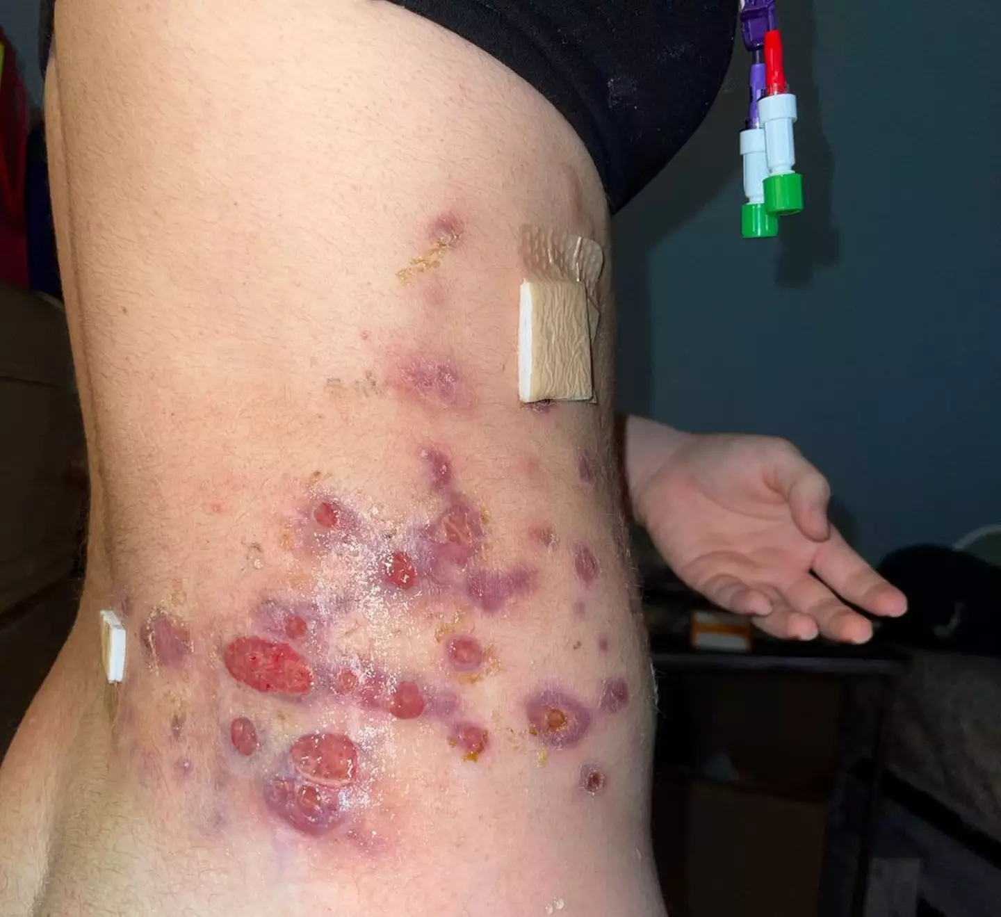 Beatriz's skin came up in 'welts'.