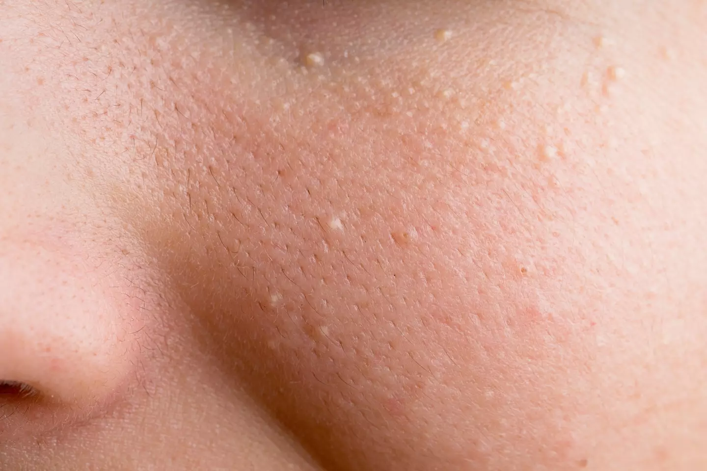 Many people experience white spots on their face and body (Getty Stock Image)
