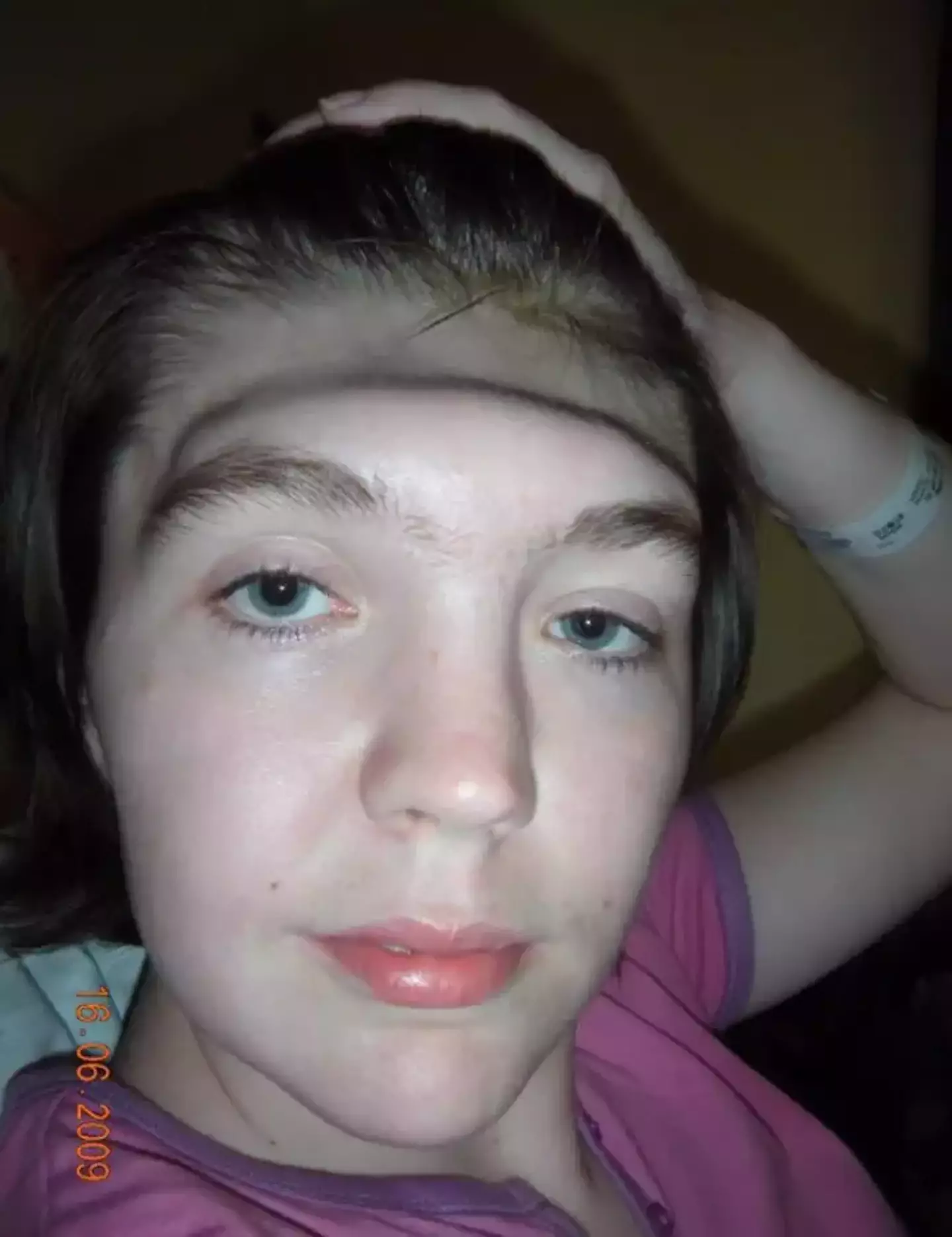 Kealy was left without a full forehead for two years. (Gráinne Kealy)