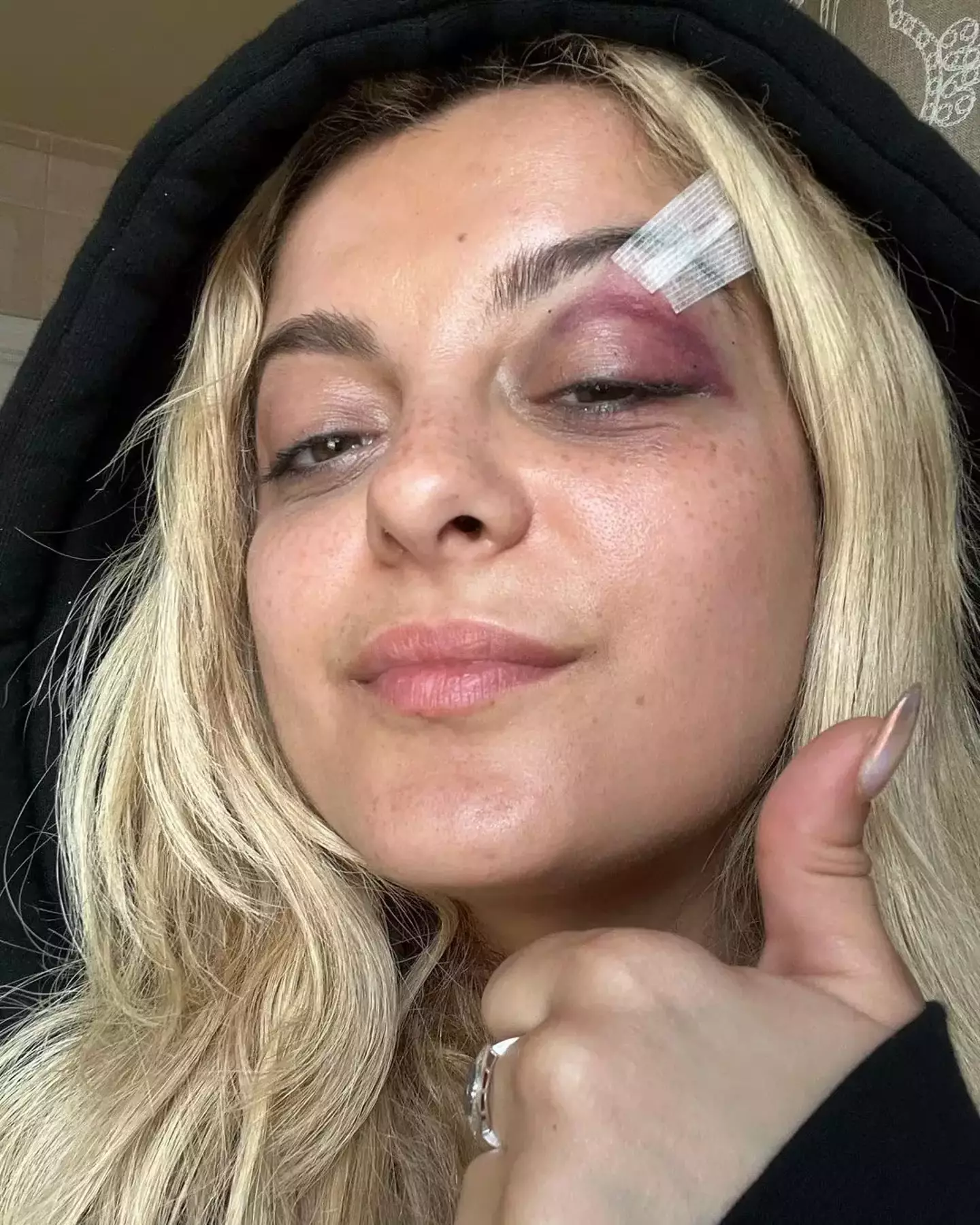 Bebe Rexha shared two pictures of her injuries.
