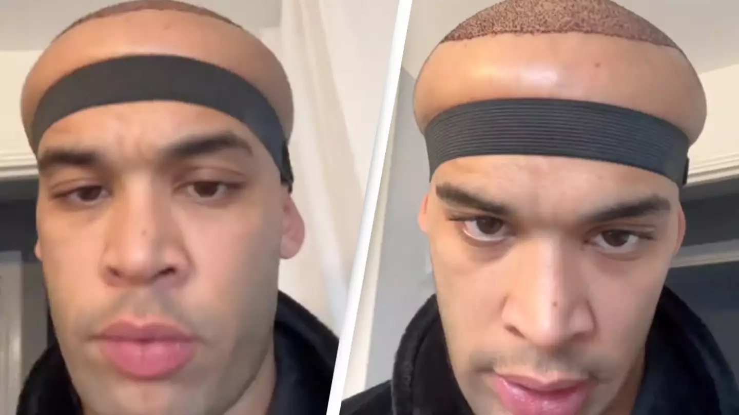 Man shows aftermath of hair transplant which he says left him 'looking like an alien'
