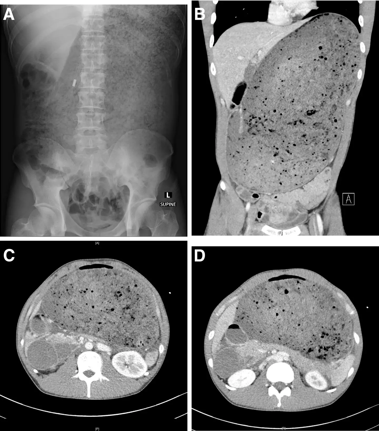 Scans of the man's distended stomach (Gastroenterology aga)