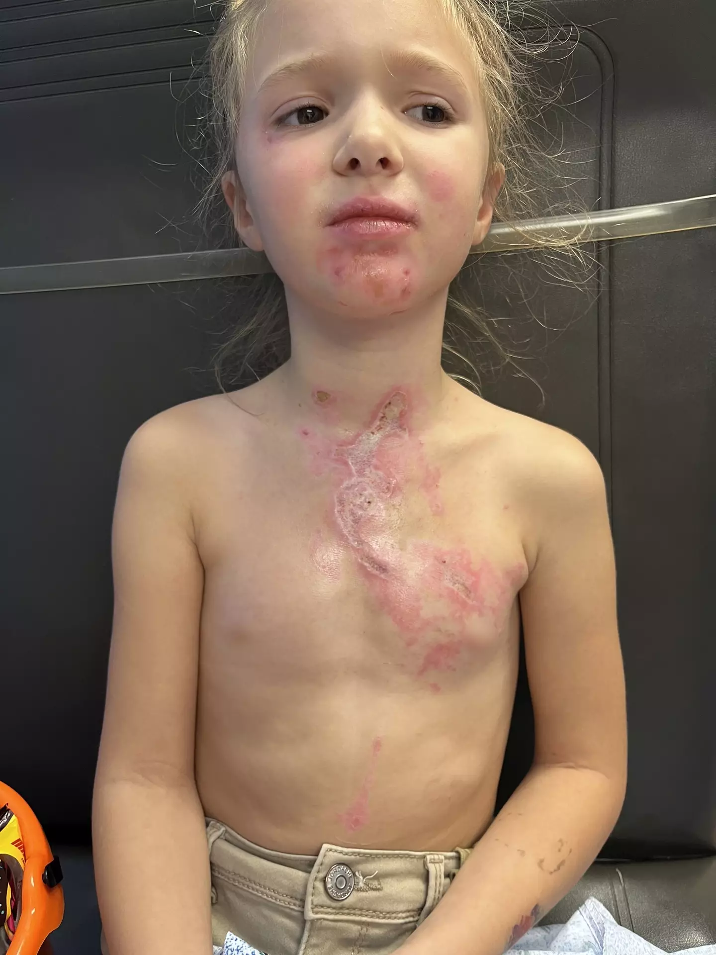 7-year-old Scarlett was left with severe scars from the incident (Kennedy News)