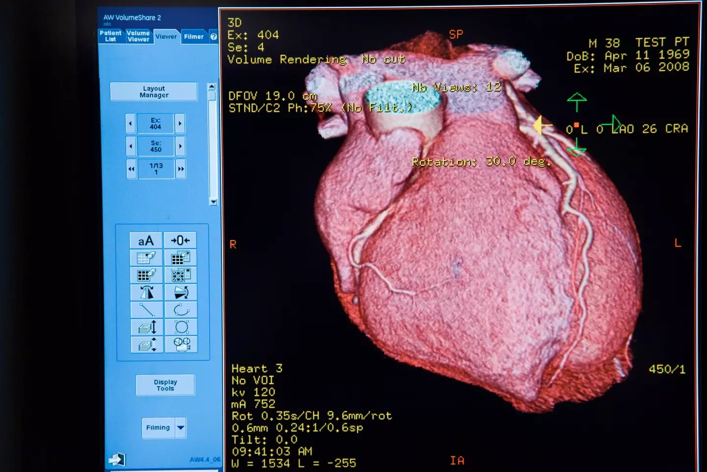 Congenital heart diseases like ASD affect almost 1 in 100 babies born in the UK (Getty Stock Image)