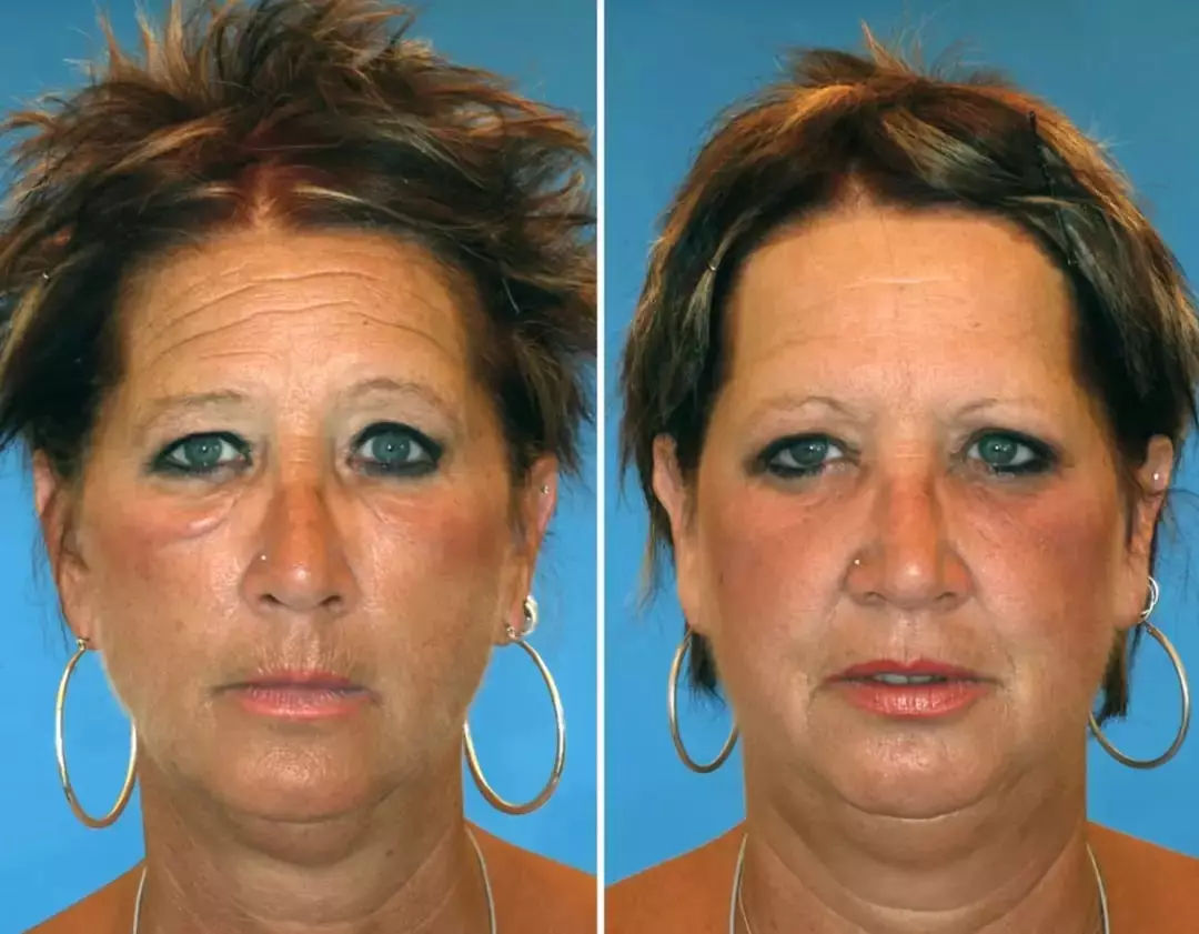 Brenda (left) and Barb (right) (American Society of Plastic Surgeons / Dr. Bahman Guyuron)