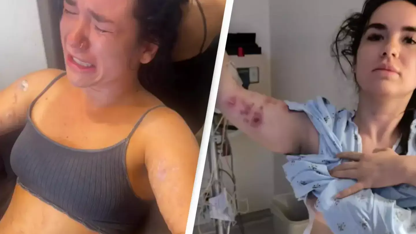 Woman watched her 'skin burst open' after fat-dissolving injections left her with flesh eating infection
