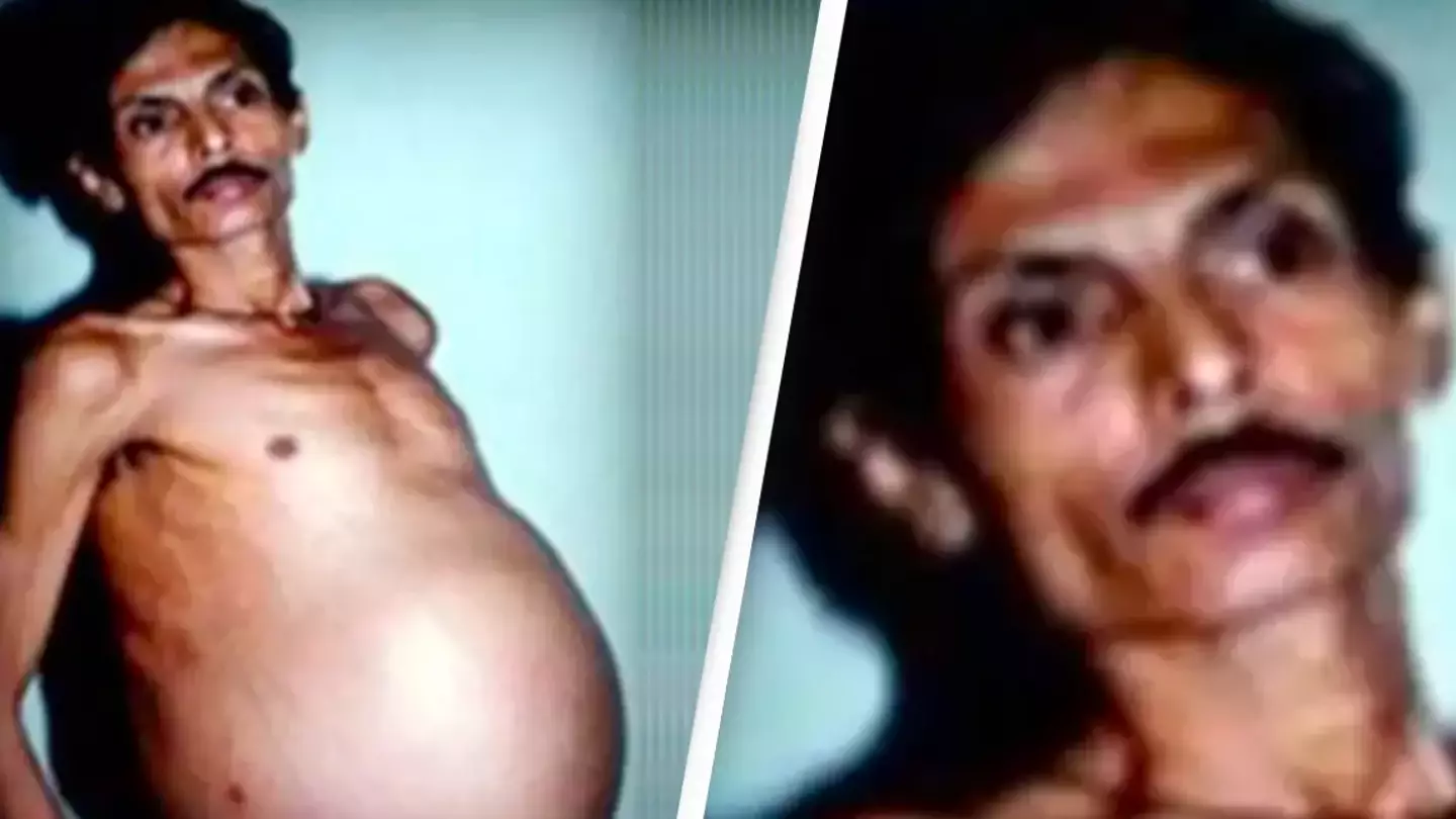 Man lived with twin inside him for 36 years without knowing