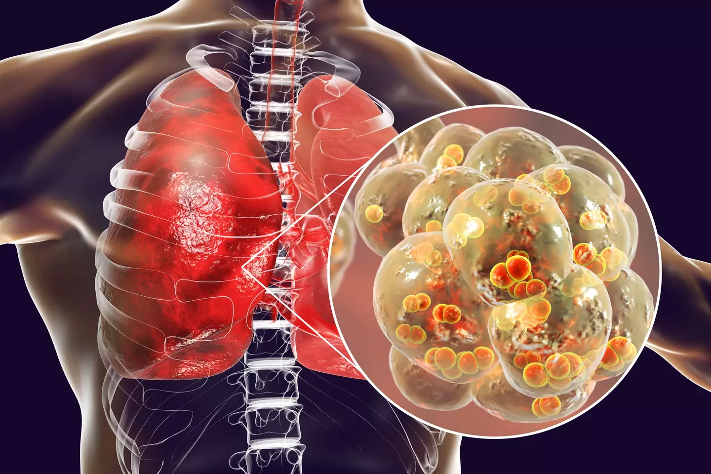 In some cases, streptococcus pneumoniae bacteria can cause pneumonia (Kateryna Kon/Science Photo Library/Getty Images)