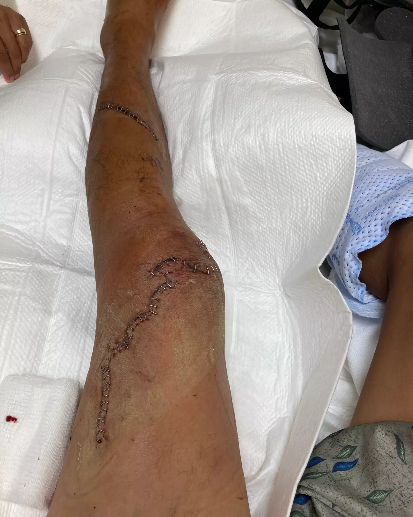 The surfer's leg was nearly bitten off by the tiger shark.