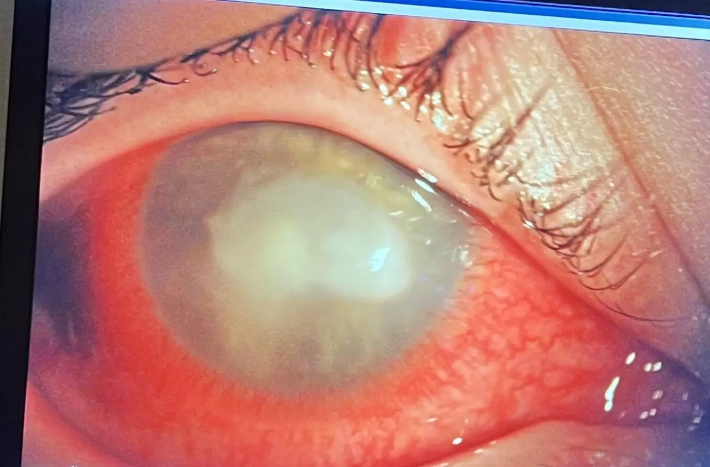 Brooklyn was diagnosed with acanthamoeba keratitis (Kennedy News and Media)