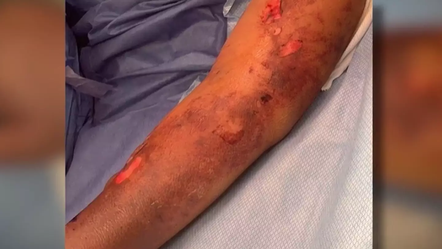 The condition made Marie's limbs necrotise (Marie Trainer)