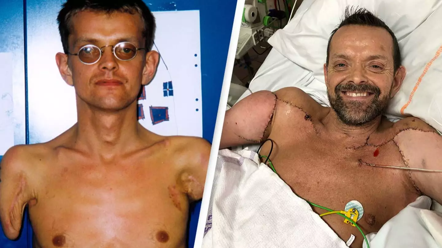 World’s First-Ever Double Arm And Shoulder Transplant Recipient Makes Incredible Recovery