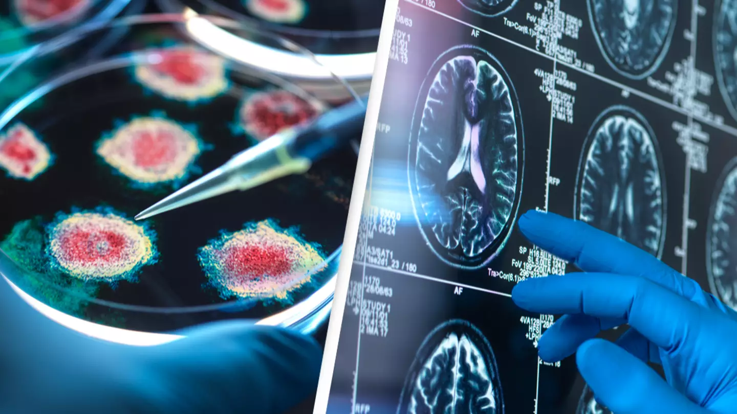 Virus that 'most people are exposed to' could be the cause of Alzheimer's in some people