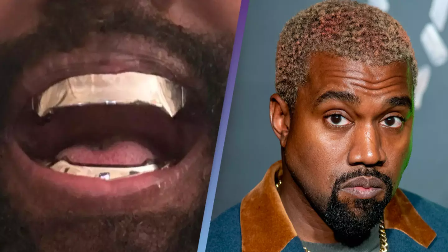 Kanye West’s 850,000 titanium teeth are ‘permanent’ and go ‘beyond Kanye West’s 850,000 titanium teeth are ‘permanent’ and go ‘beyond