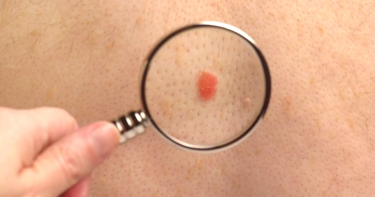 The dangers of melanoma have been explained (Getty Stock Photo)