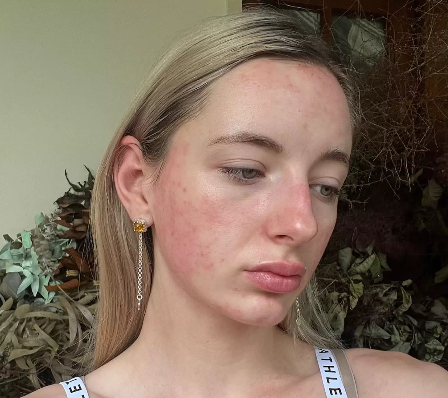 Poppy developed a rash on her face after drinking.