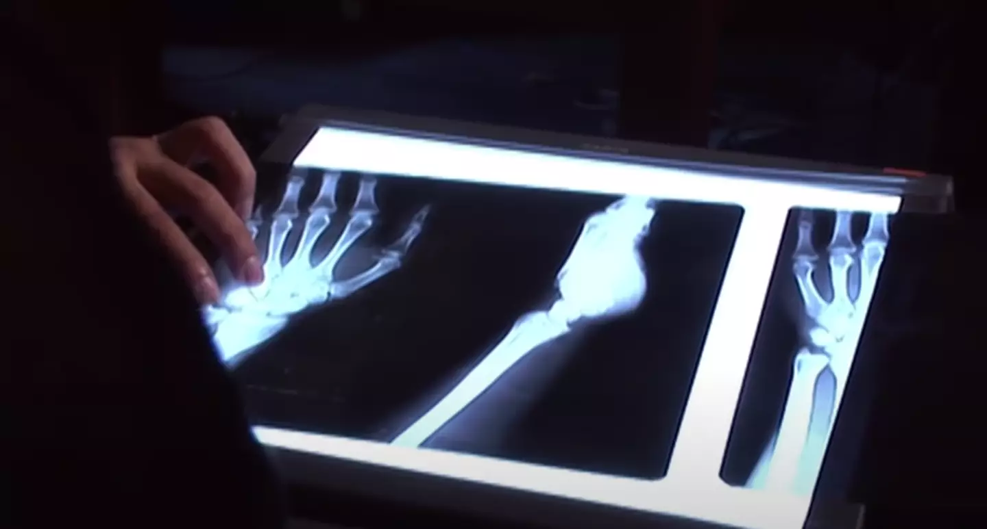 The bone structures of the affected children were also analysed by scientists.