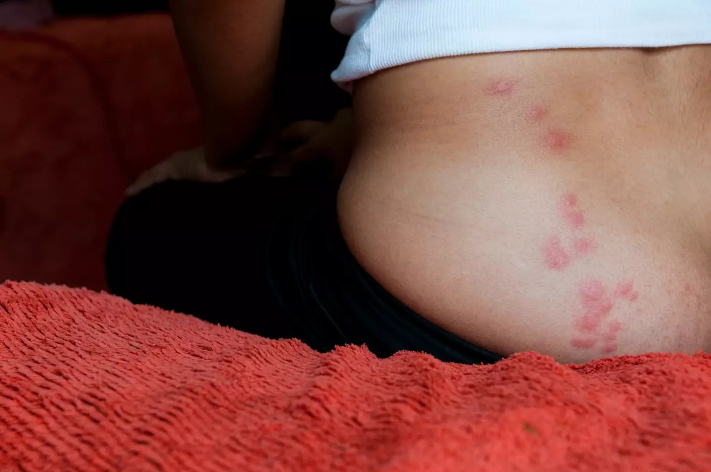 Bedbug bites can cause irritation and increase risk of skin infections.