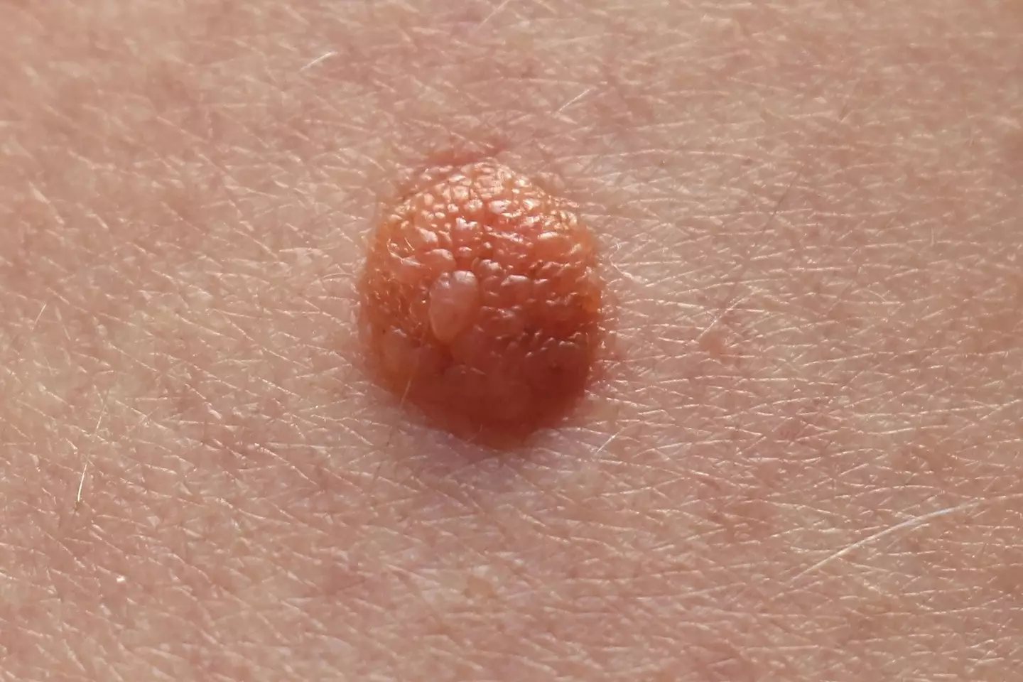 Scientists hope to develop a drug to treat melanoma.