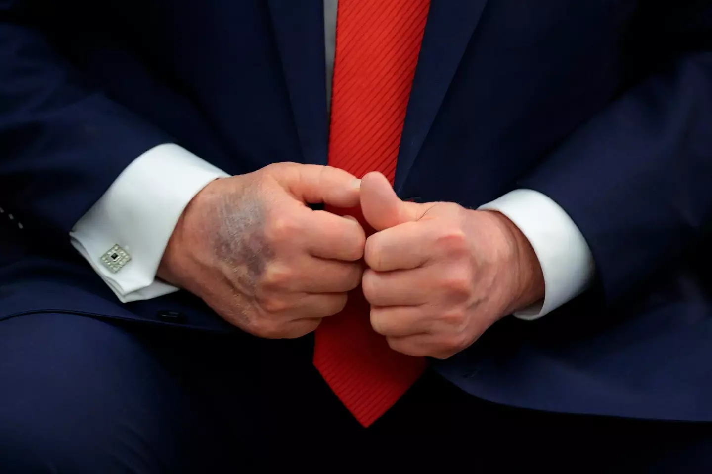 Many spotted the 'large bruise' (Chip Somodevilla/Getty Images)