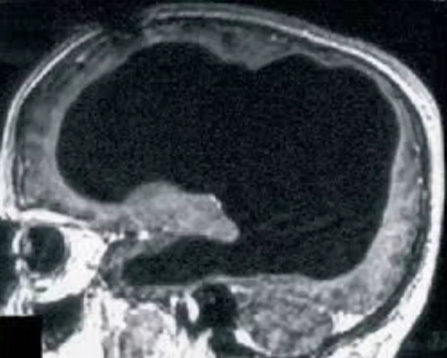 The scan should show the man's brain... except most of it is missing. (Feuillet et al./The Lancet)