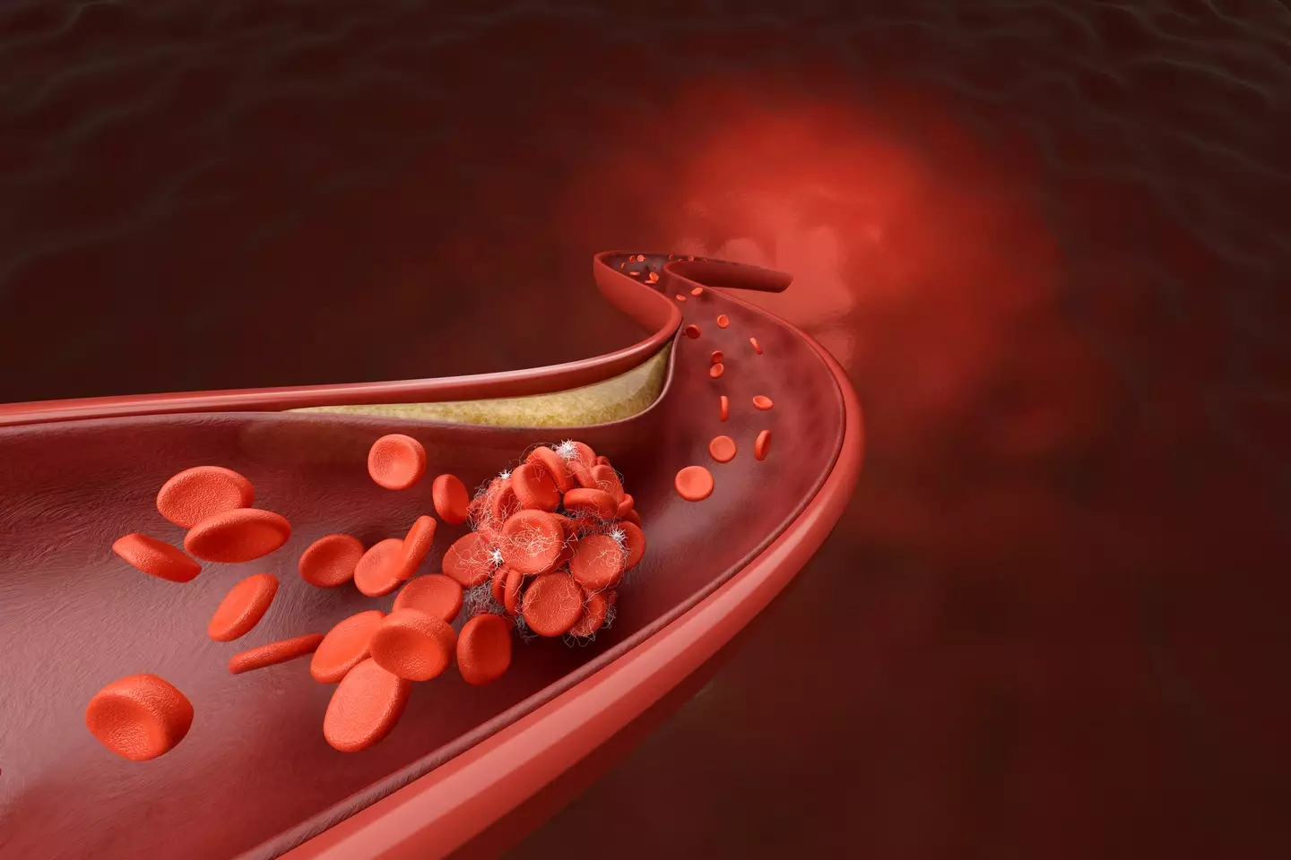 Our blood cells can become blocked by cholesterol, leading to stroke or other heart diseases (Getty Stock Image)