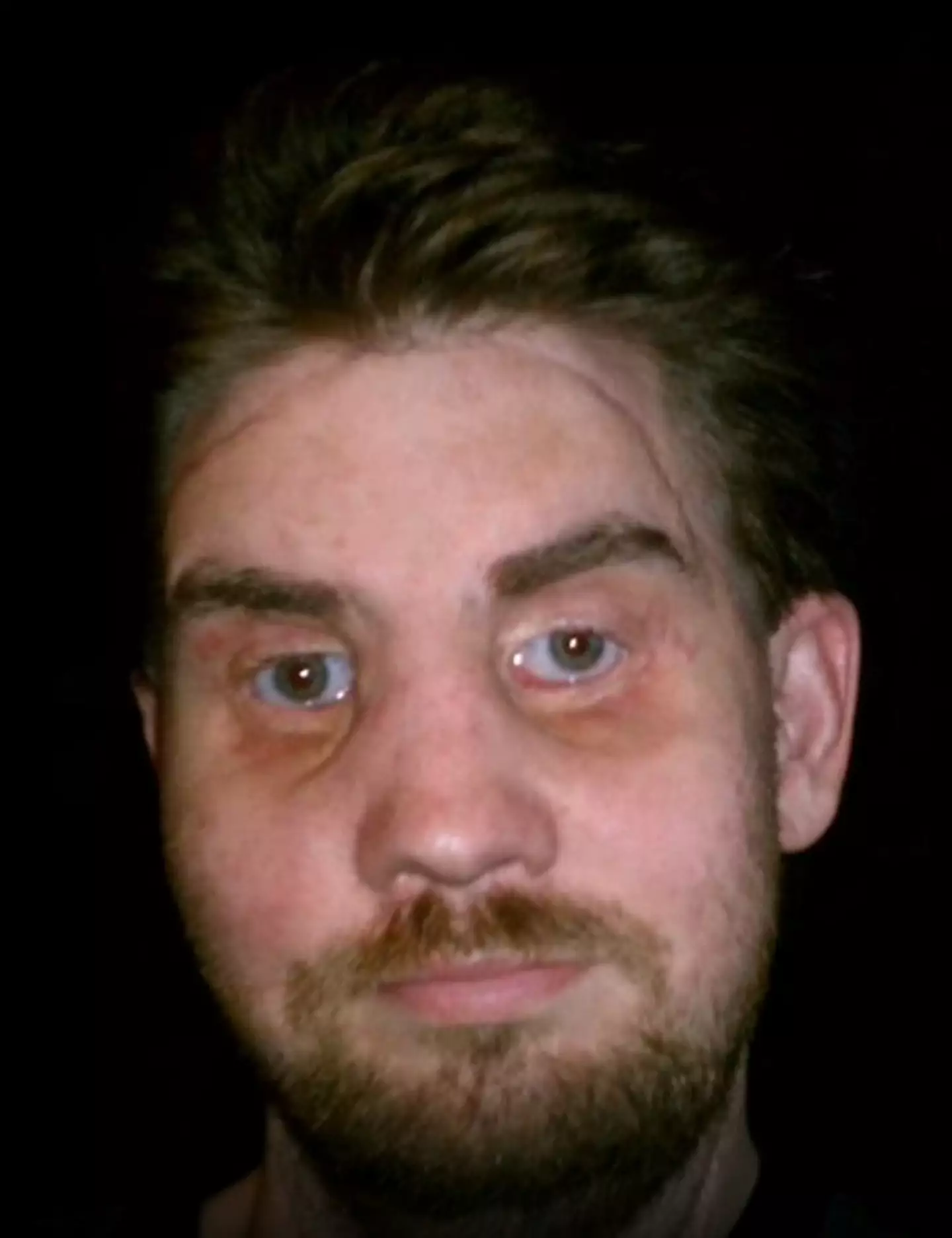 Mitch underwent a face transplant for his children.