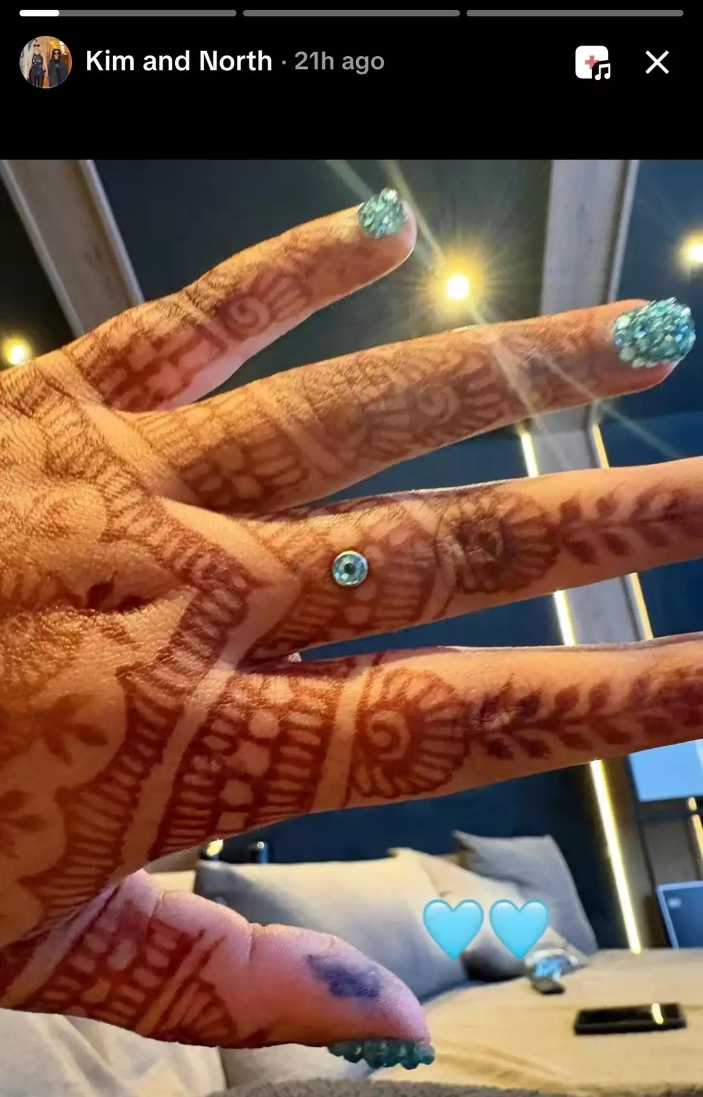 North has previously shared her new dermal implants on an old Instagram that she shared with mom Kim (Instagram/NorthAndKim)