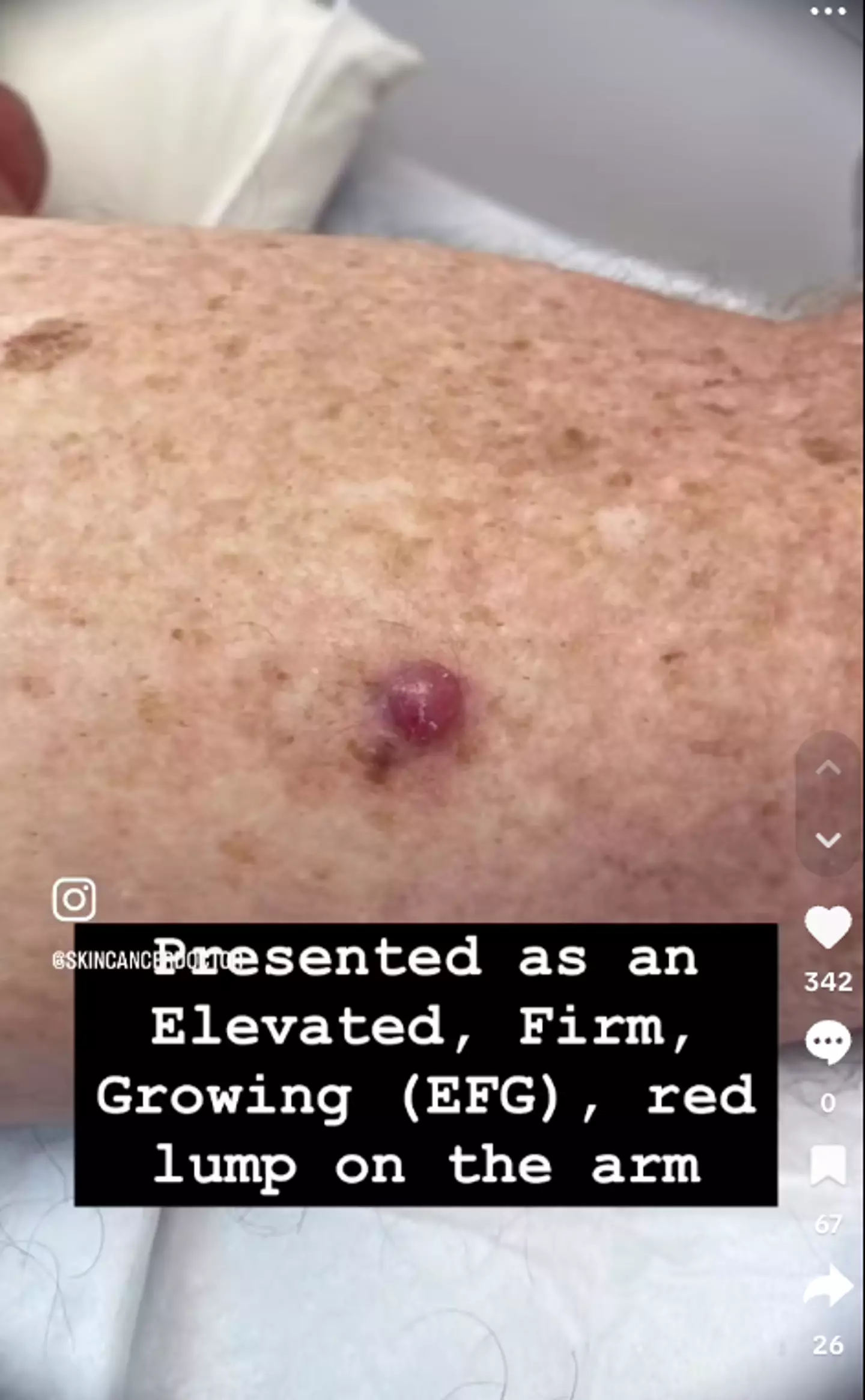 How it looked from the surface (@skincancerdoctor/TikTok)