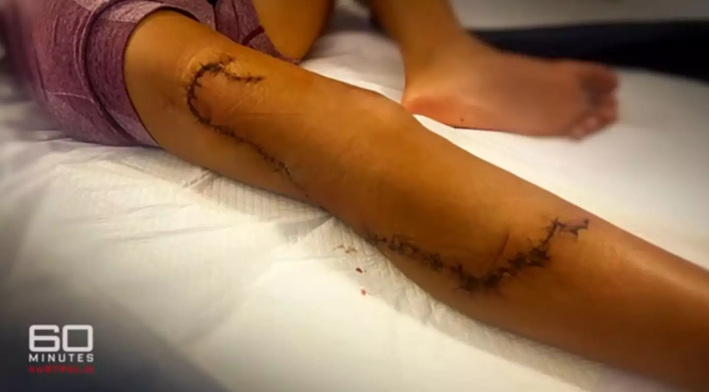 The result of the shark attack (60 Minutes Australia)