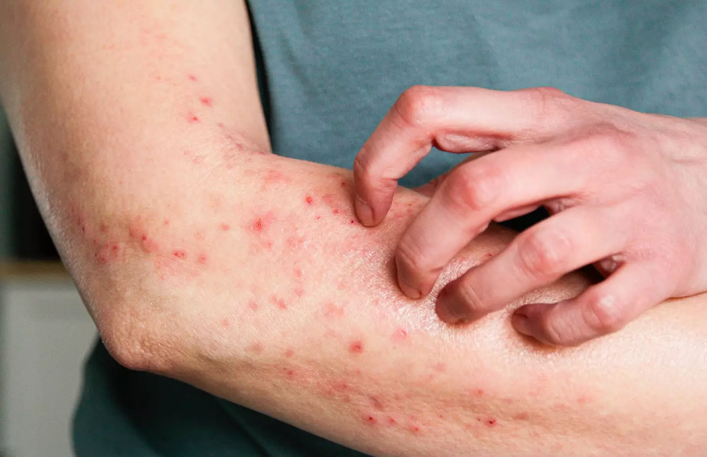People with eczema and asthma are most at risk of developing anaphylaxis (Getty Images)