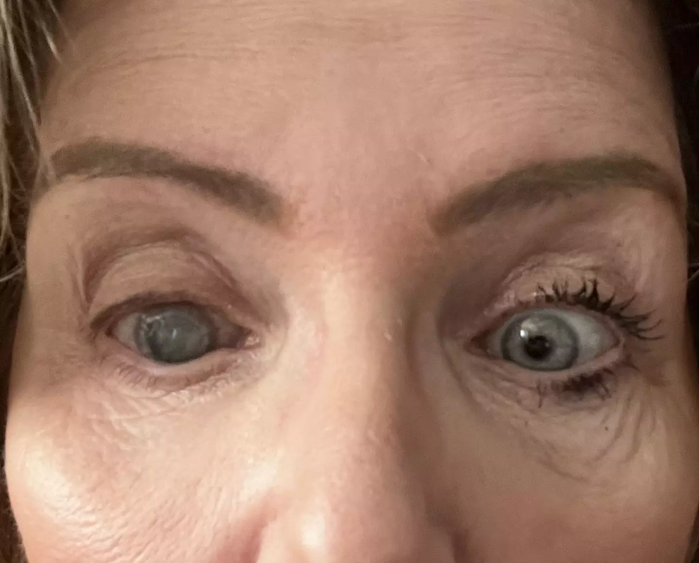 Maureen's eye ended up clouding over (Kennedy News and Media)