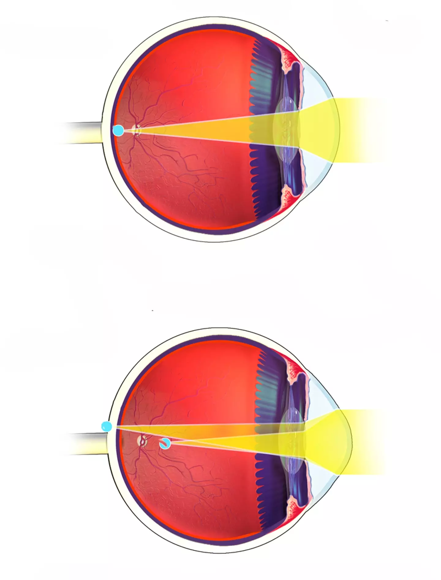 Astigmatism (shown at the bottom) leaves people with different shaped eyes. (Wikimedia Commons)