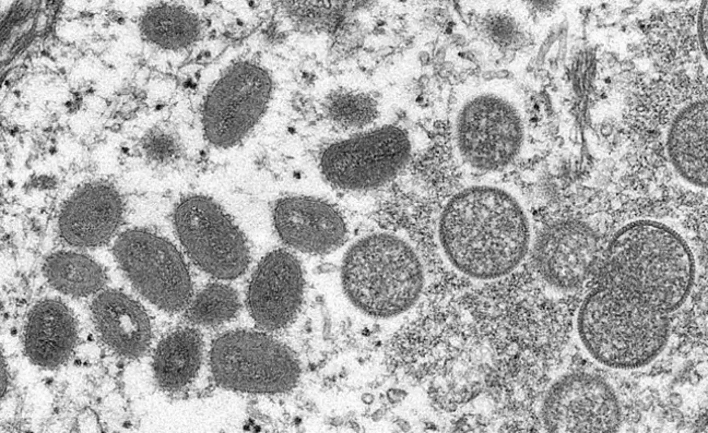 A US resident sadly died from monkeypox.