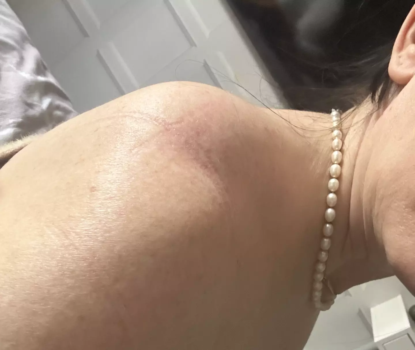 Claire had noticed swelling in her shoulder (Kennedy News and Media)