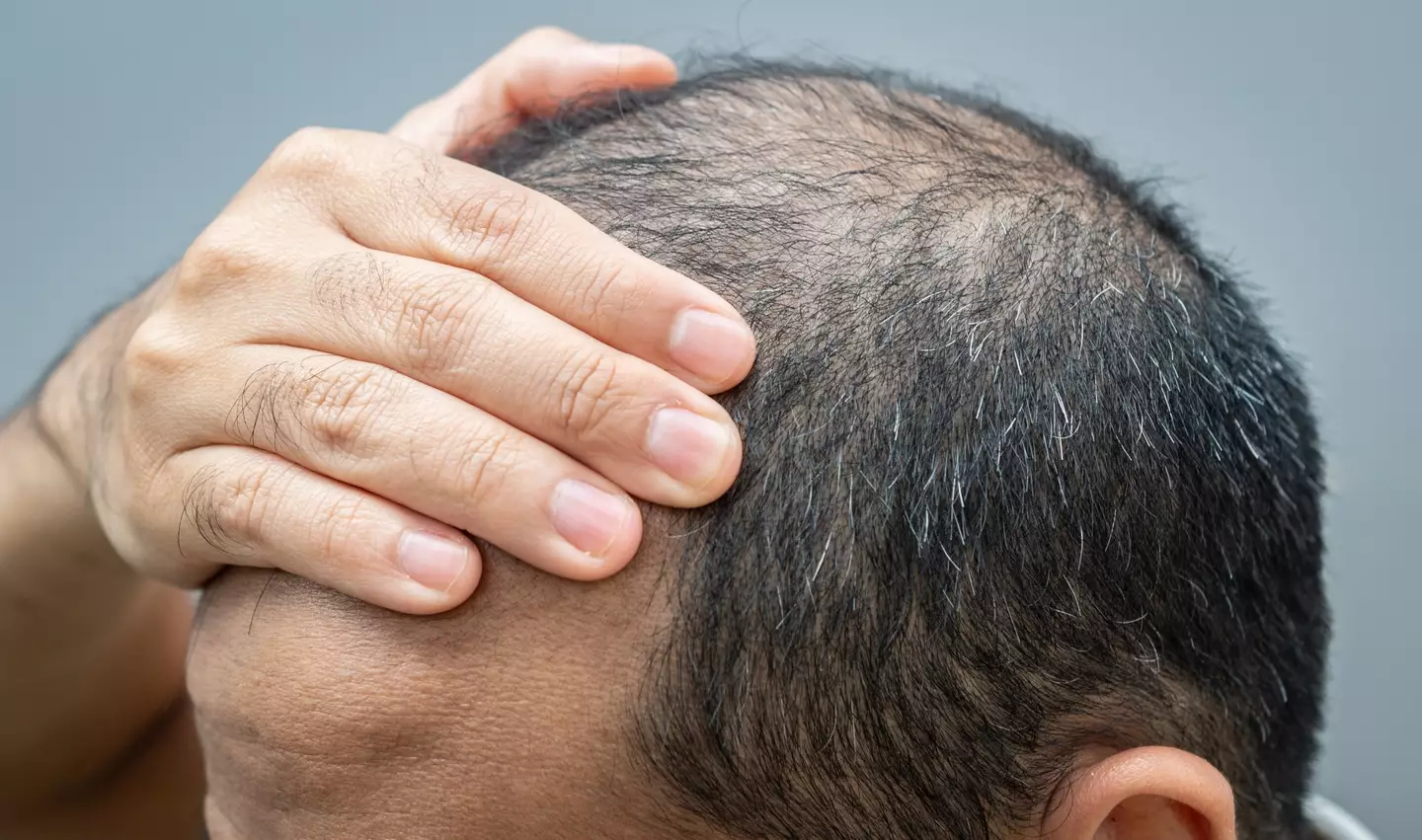 Want to know if you're going to go bald later in life? (Getty Stock Image)