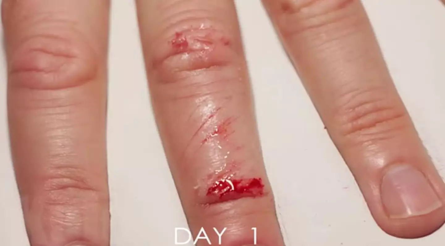 A YouTuber decided to document the healing process of an open finger wound.
