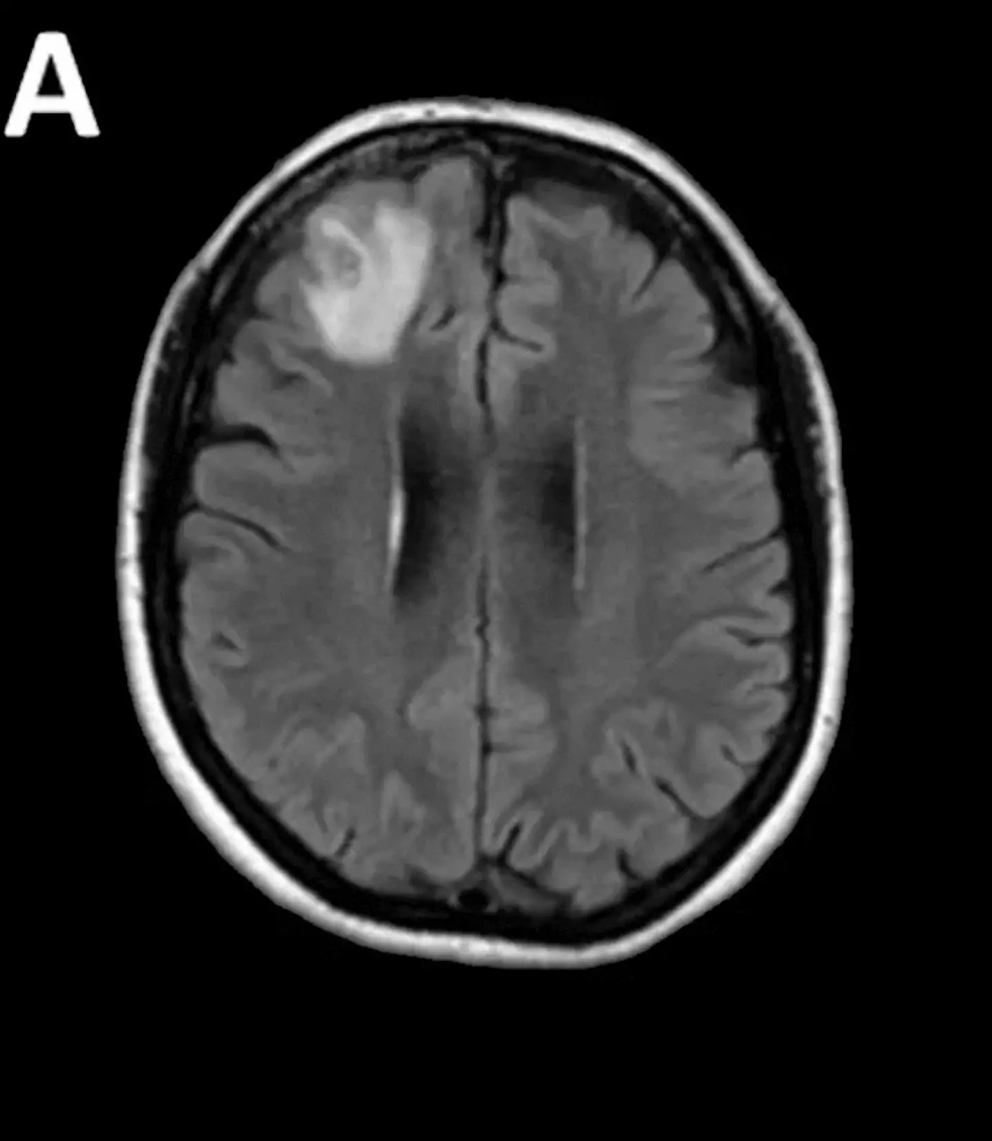 Scans had revealed alarmingly changes in the woman's brain.