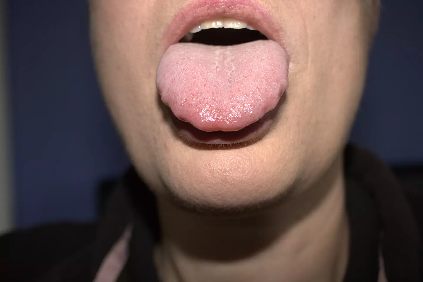 Someone with macroglossia will have an usually large tongue (Getty Stock)