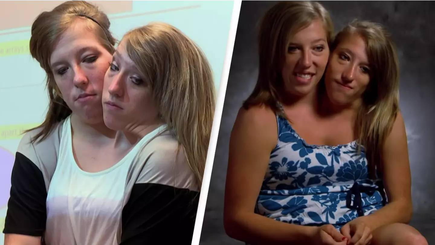 Conjoined twins opened up on what their life was like after becoming teachers