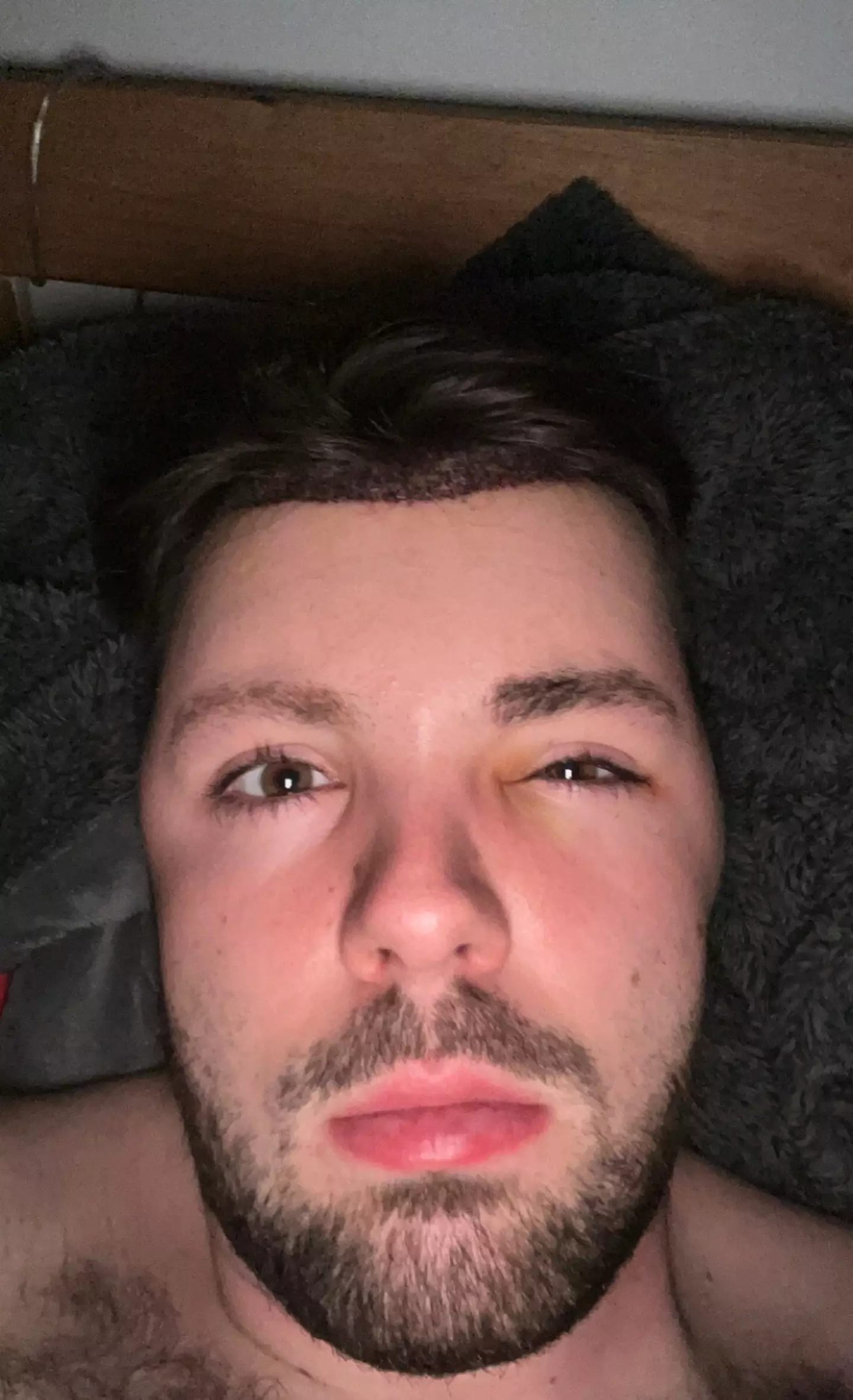 Owen was left with severe swelling after he ignored medical advice after a hair transplant (SWNS)