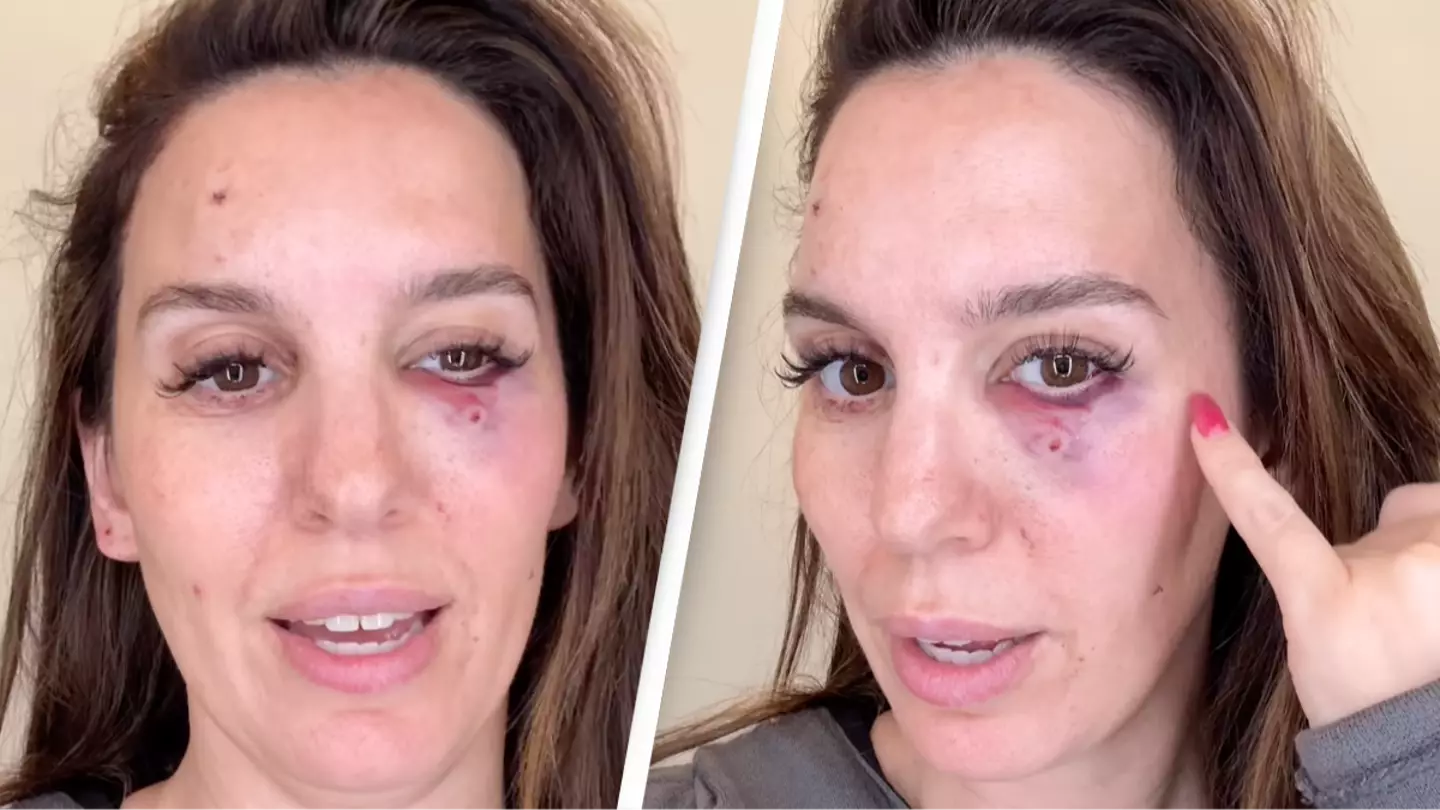 Disney star Christy Carlson Romano reveals shocking video after being 'shot in the eye' at husband's birthday party