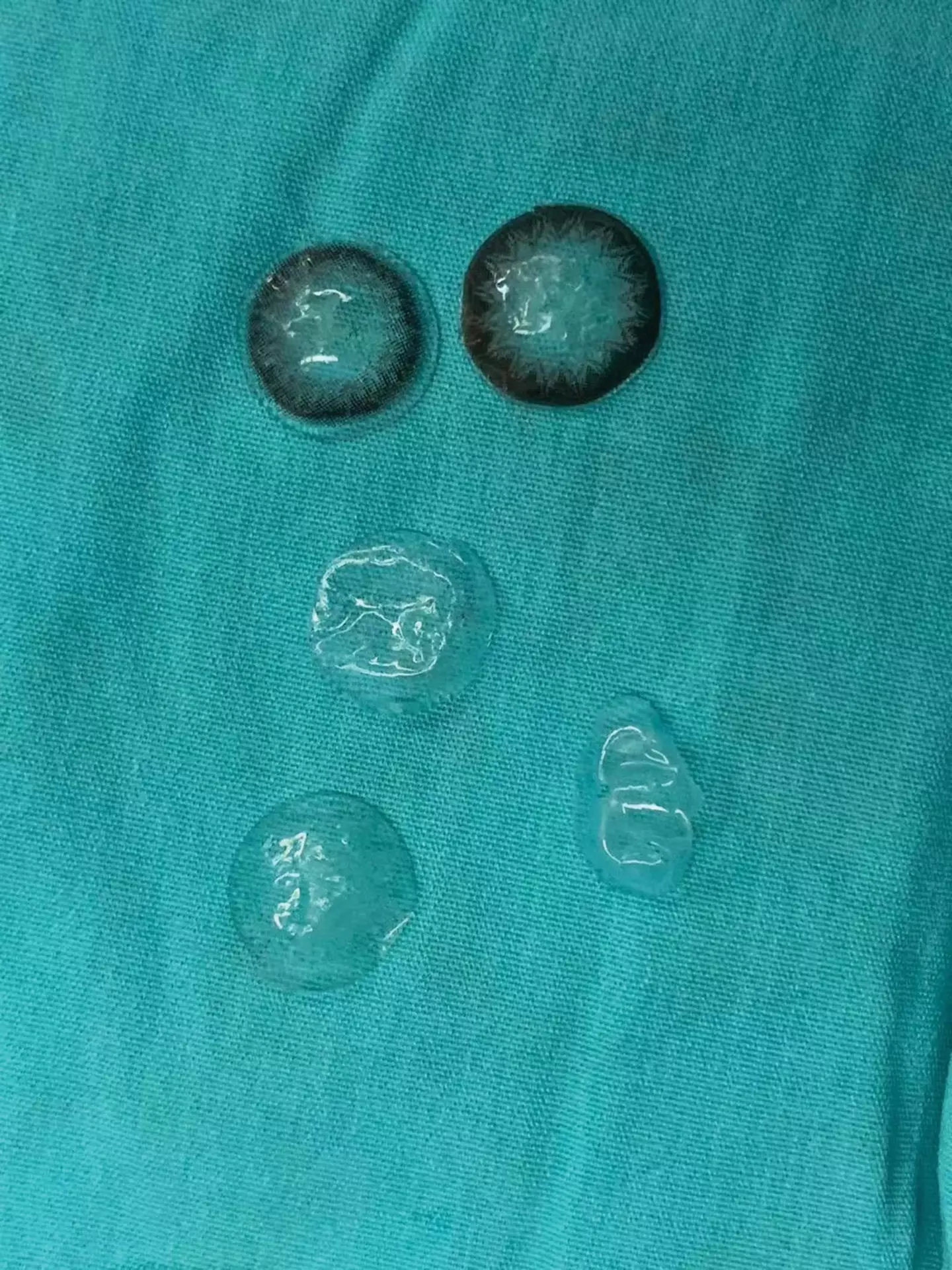 The five contact lenses found behind her eye...(Plastic and Reconstructive Surgery)