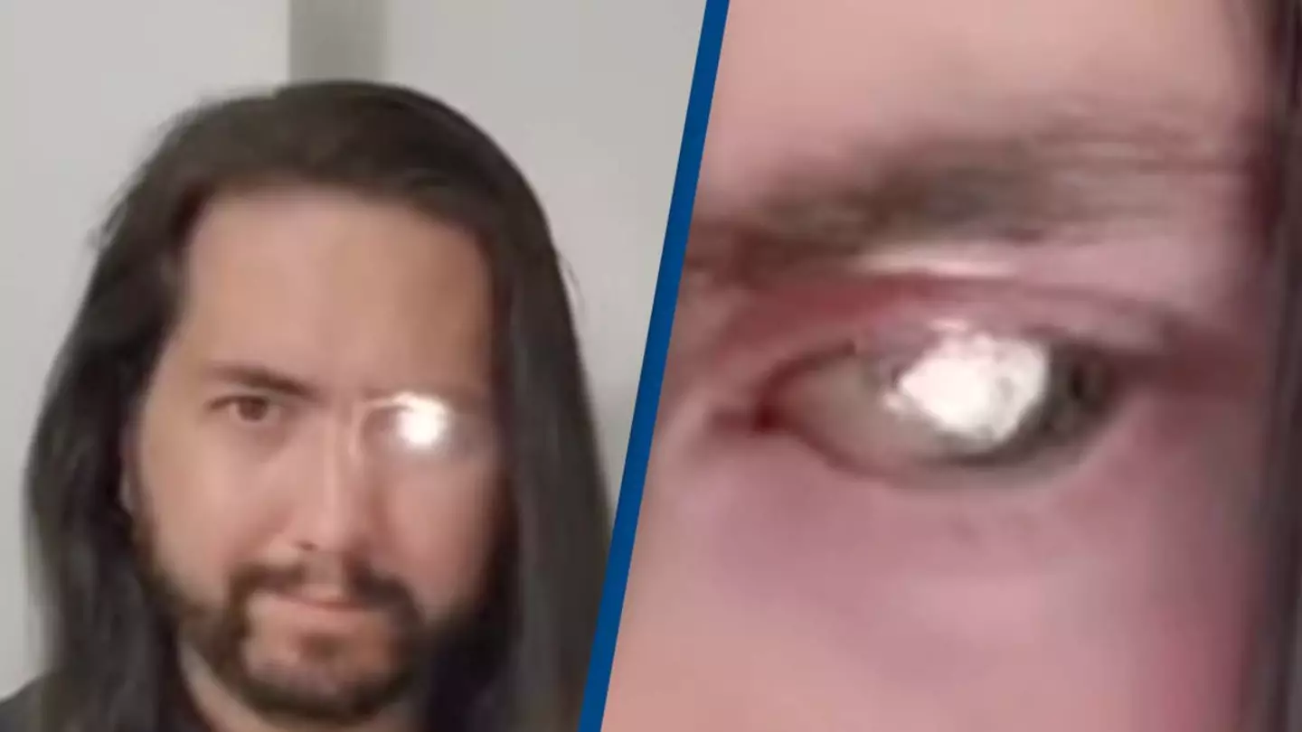 Man turns his eye into a flashlight after losing it to cancer