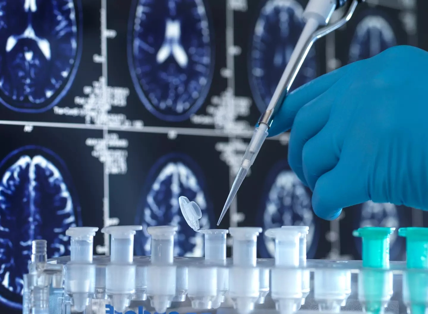 NRTIs could help prevent Alzheimer's (Getty Stock Images)