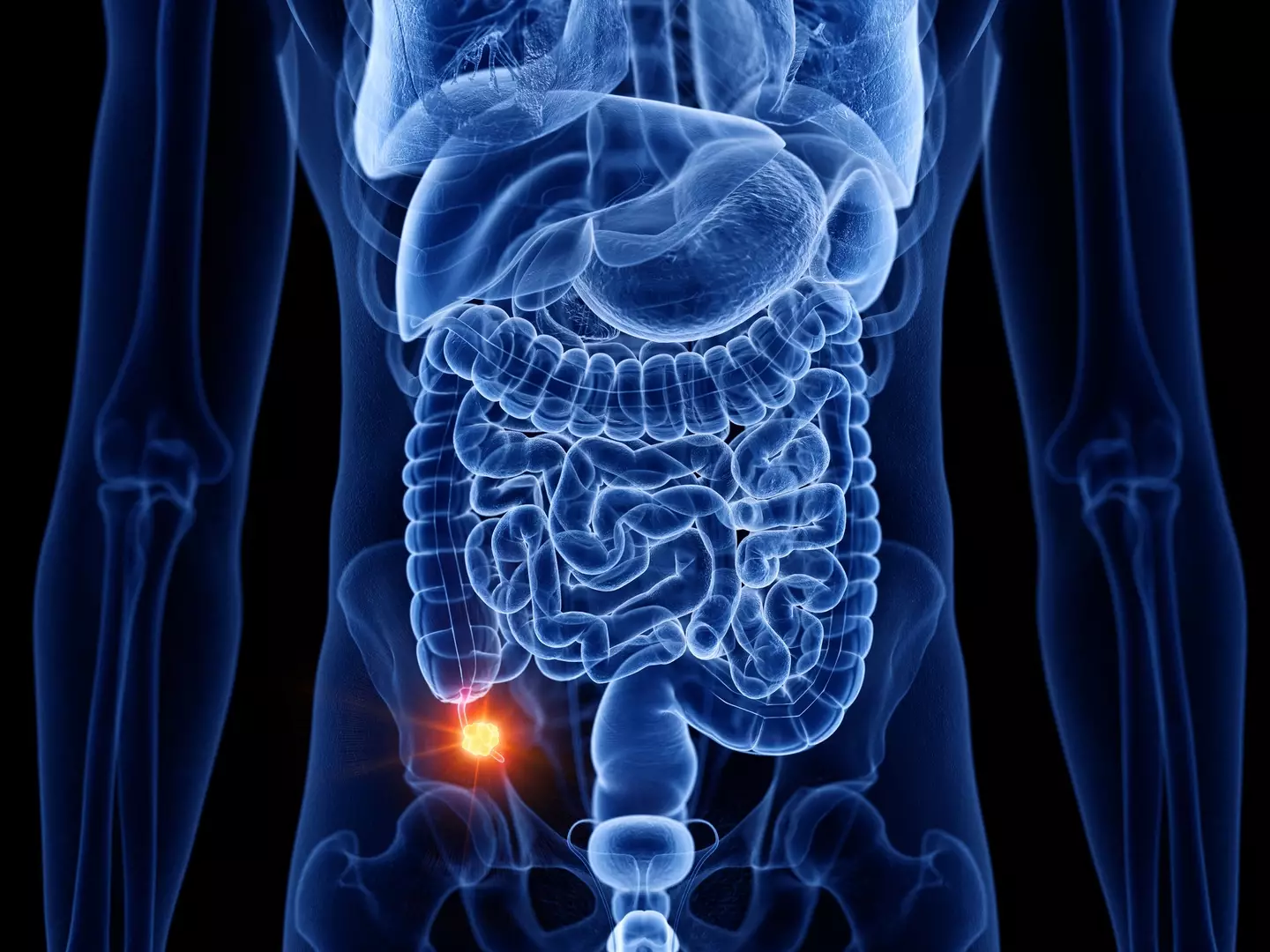 Cases of people below the age of 50 getting appendix cancer has gone up (Getty Stock Image)