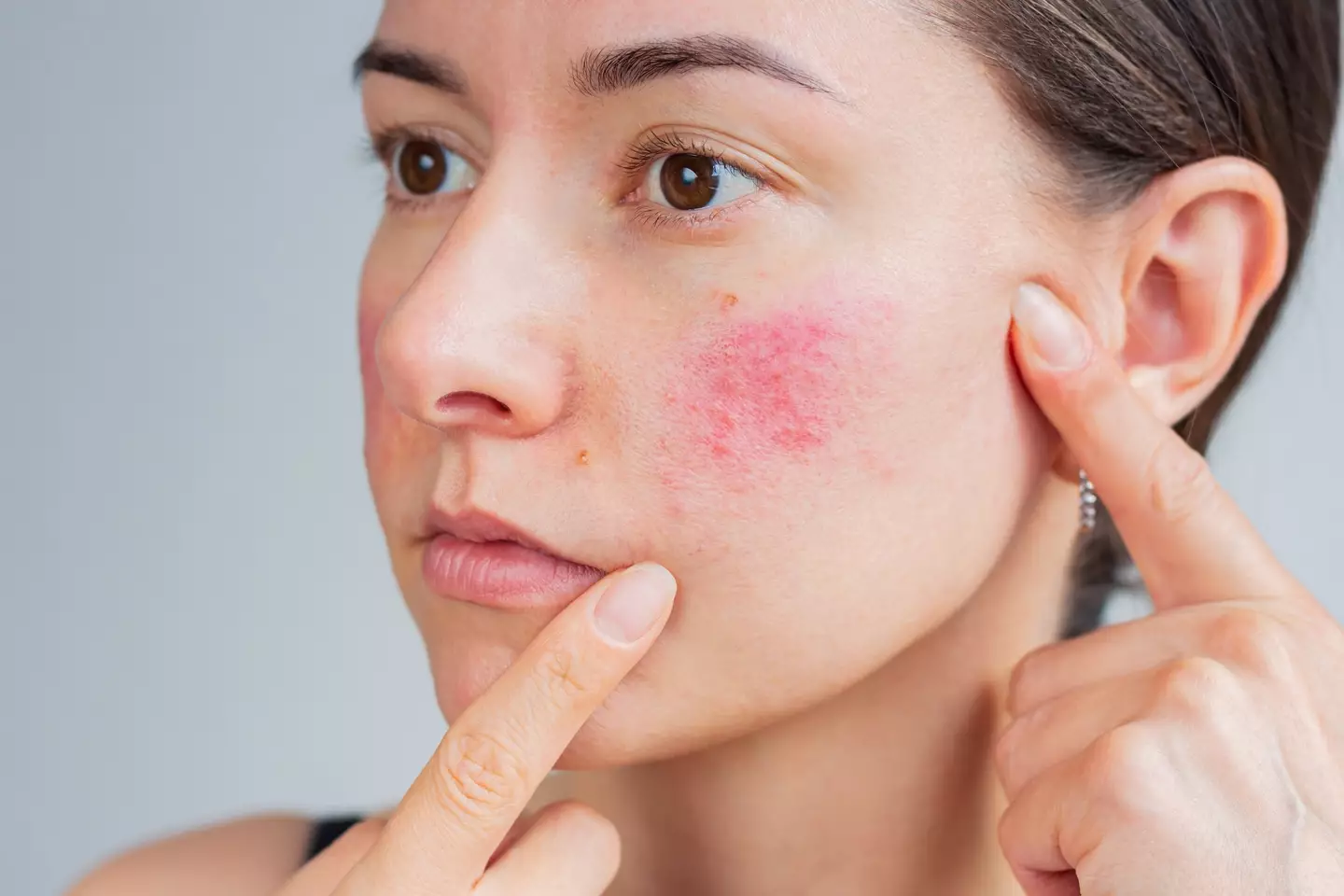A facial rash is one of lupus' visible symptoms (Olga Shefer/Getty Images)